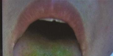 吃瓜后舌头黑,揭秘黑色现象背后的秘密